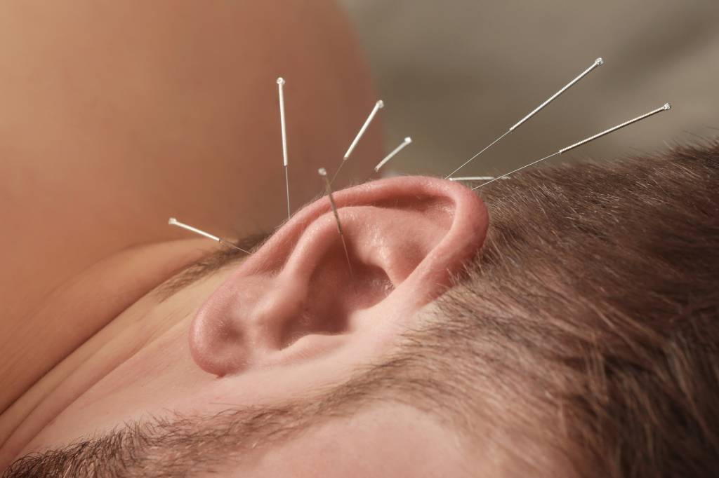 ear seeds acupuncture alternative
