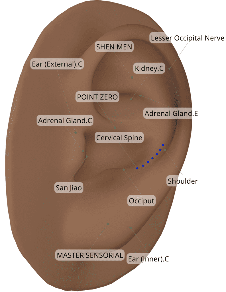 Ear seeds for Tinnitus Placement Chart for Acupoints
